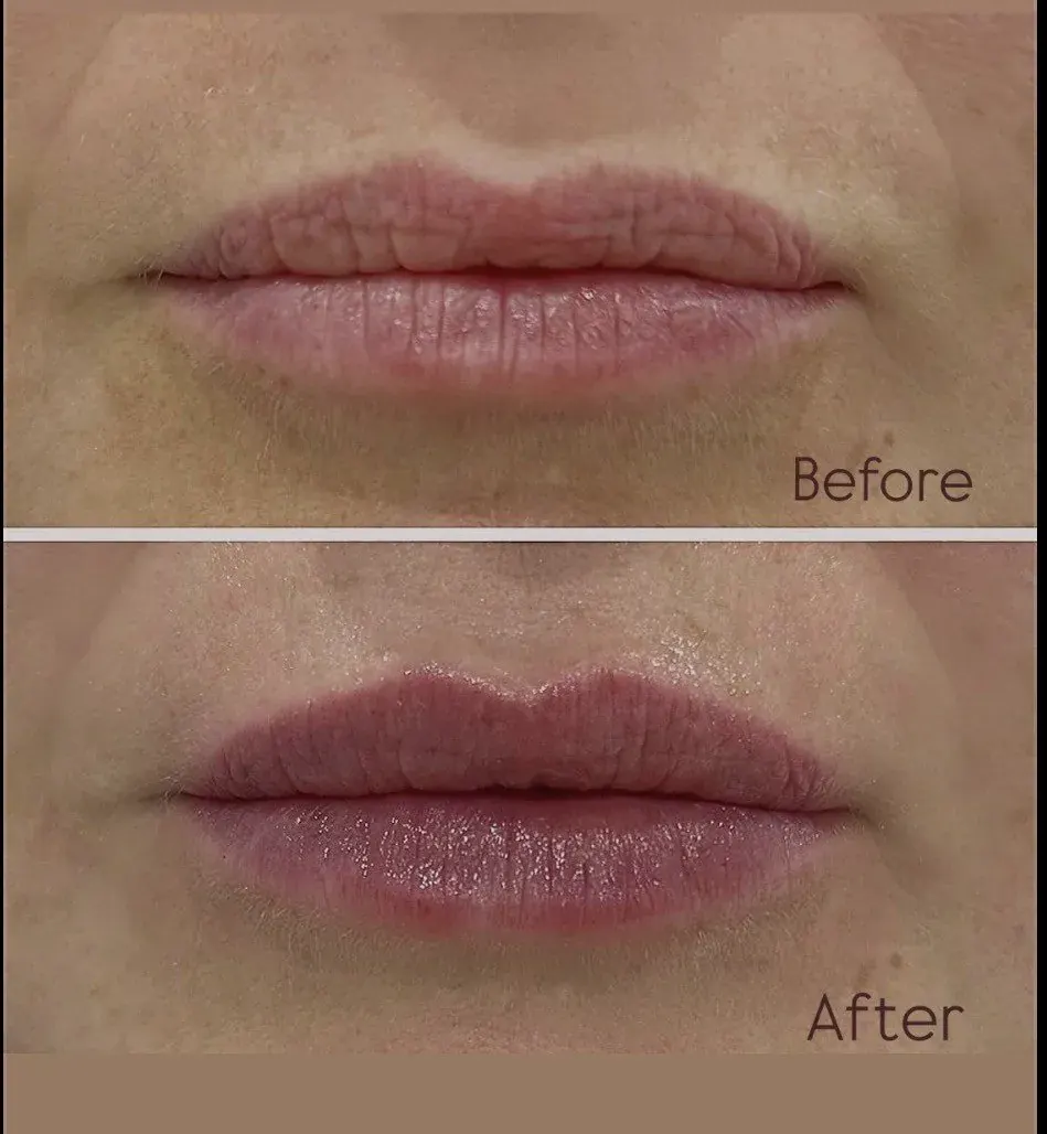 Dermal Filler before and after