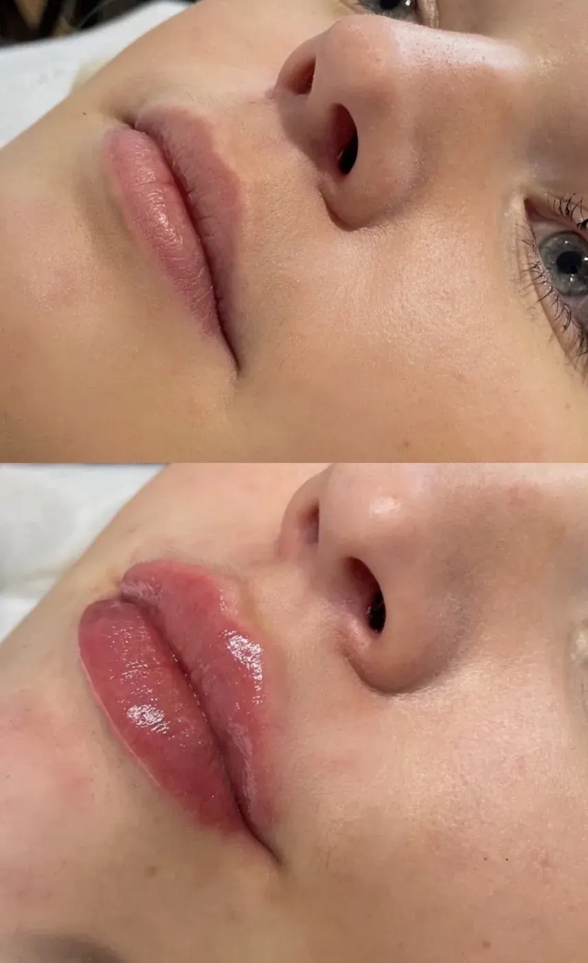 Dermal Filler before and after