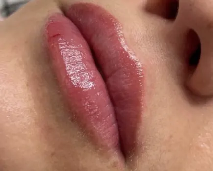 Filler · Microneedling · Skin Boosters